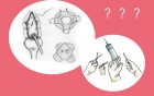 宫颈环扎术——让胎儿来了不走的“安全锁”